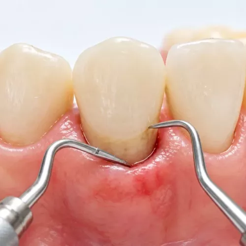 Servicio de periodoncia de Clínica Dental Isabel Cuesta en Siero