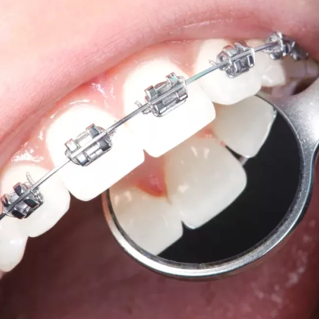 Ortodoncia en Clínica Dental Isabel Cuesta en Siero