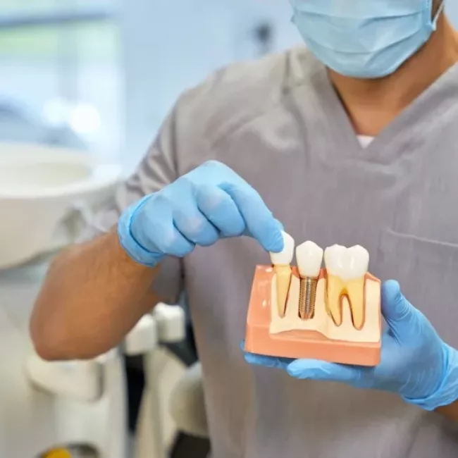 Tratamiento de implantes dentales de Clínica Dental Isabel Cuesta en Siero