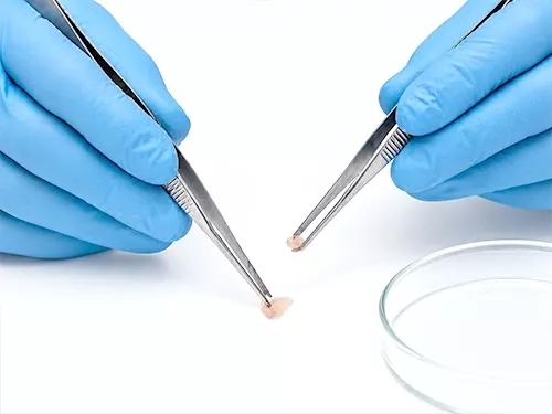 biopsiasoraleslafresnedasiero