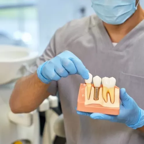 Tratamiento de implantes dentales de Clínica Dental Isabel Cuesta en Siero