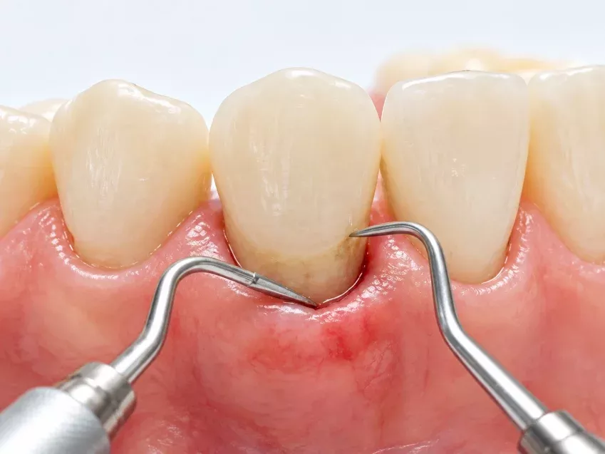 Servicio de periodoncia de Clínica Dental Isabel Cuesta en Siero