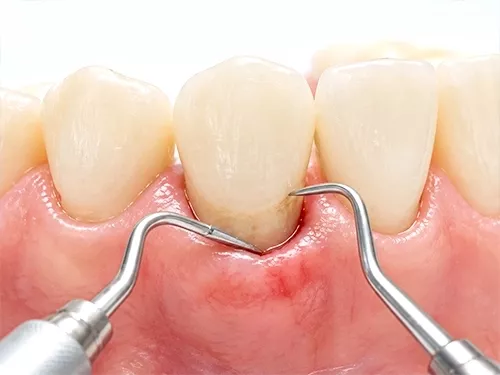 periodonciafresnedasiero