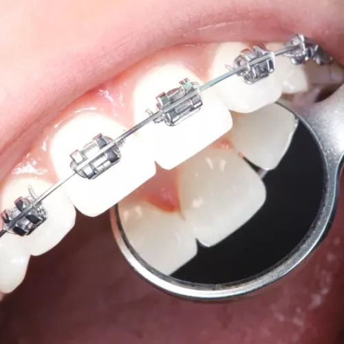 Ortodoncia en Clínica Dental Isabel Cuesta en Siero