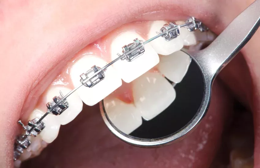 Ortodoncia en Clínica Dental Isabel Cuesta en Siero