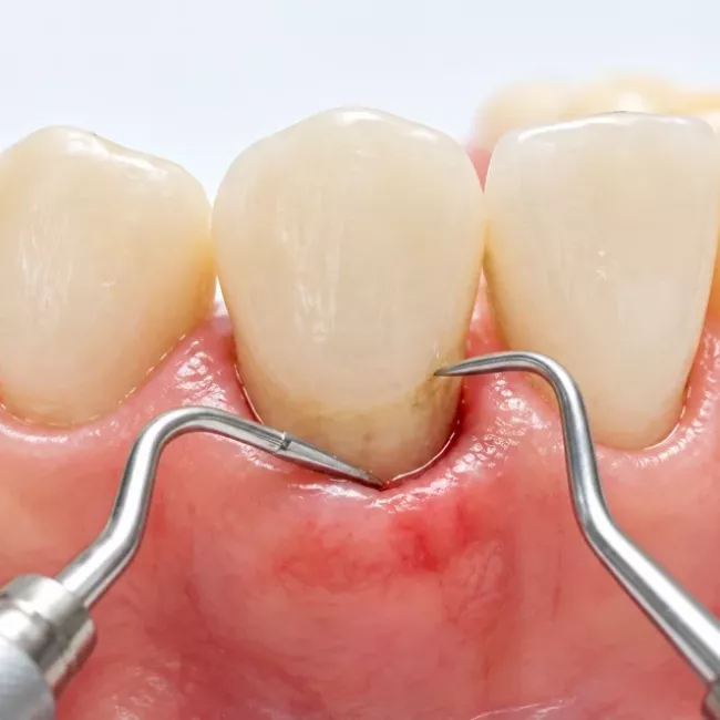 Servicio de periodoncia de Clínica Dental Isabel Cuesta en Siero